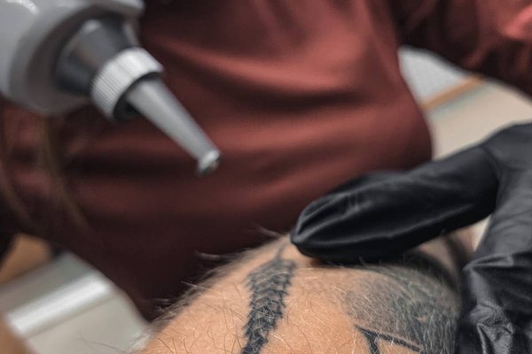 Laser tattoo removal in Vancouver