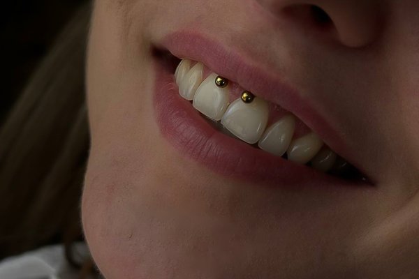 Smiley Piercing