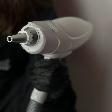 Laser tattoo removal in Vancouver