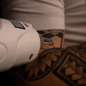 Laser tattoo removal in Vancouver