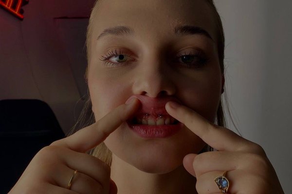 Smiley Piercing
